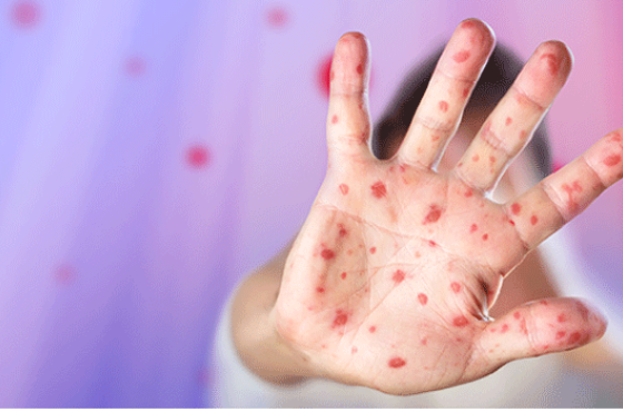 იმერეთში "ჩუტყვავილას" შემთხვევებმა იმატა