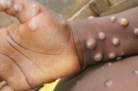 ბელგიამ ,,მაიმუნის ყვავილით'' დაავადებულებისთვის 21-დღიანი კარანტინი დააწესა