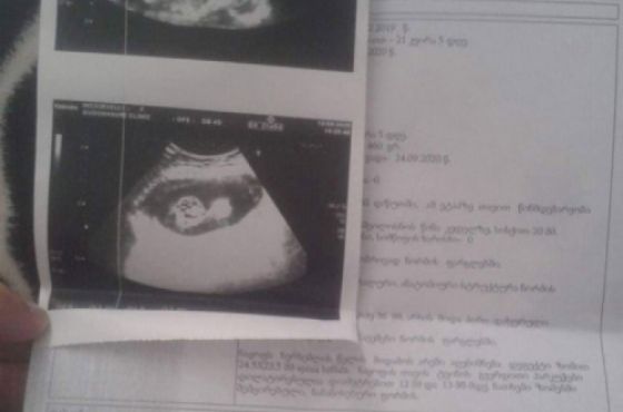 ქუთაისიპოსტზე გამოქვეყნებული მასალის შემდეგ ახალგაზრდა წყვილს ოპერაციას სრულად დაუფინანსებენ